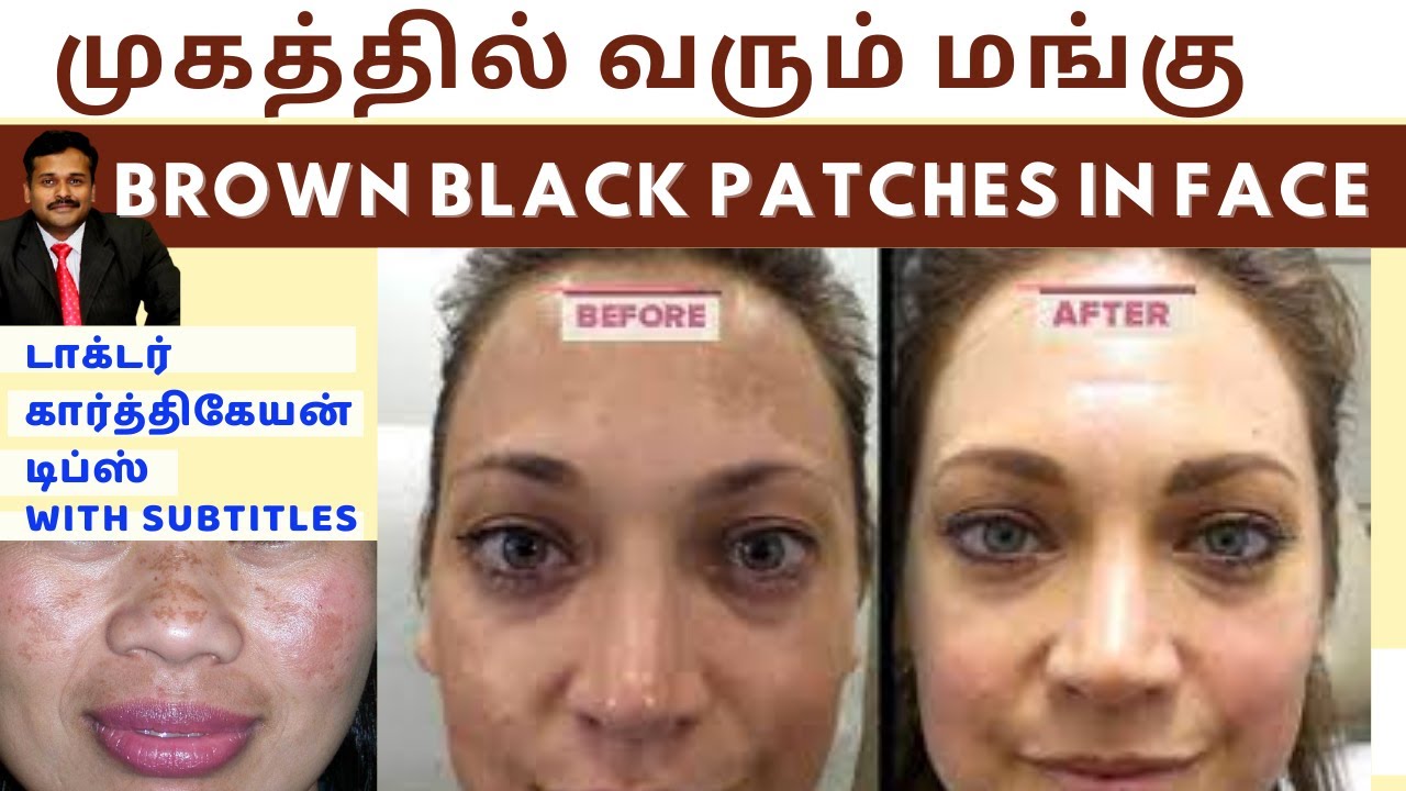 மங்கு மறைய டிப்ஸ்|Home remedies to remove brown black patches spots hyperpigmentation on face skin