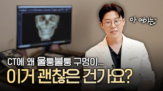 윤곽수술 후 CT, 왜 구멍난 것처럼 보일까?👀