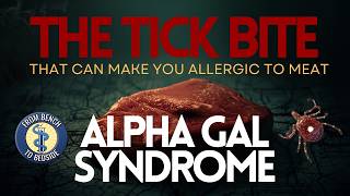 How Tick Bites Can Trigger a Life-Threatening Meat Allergy