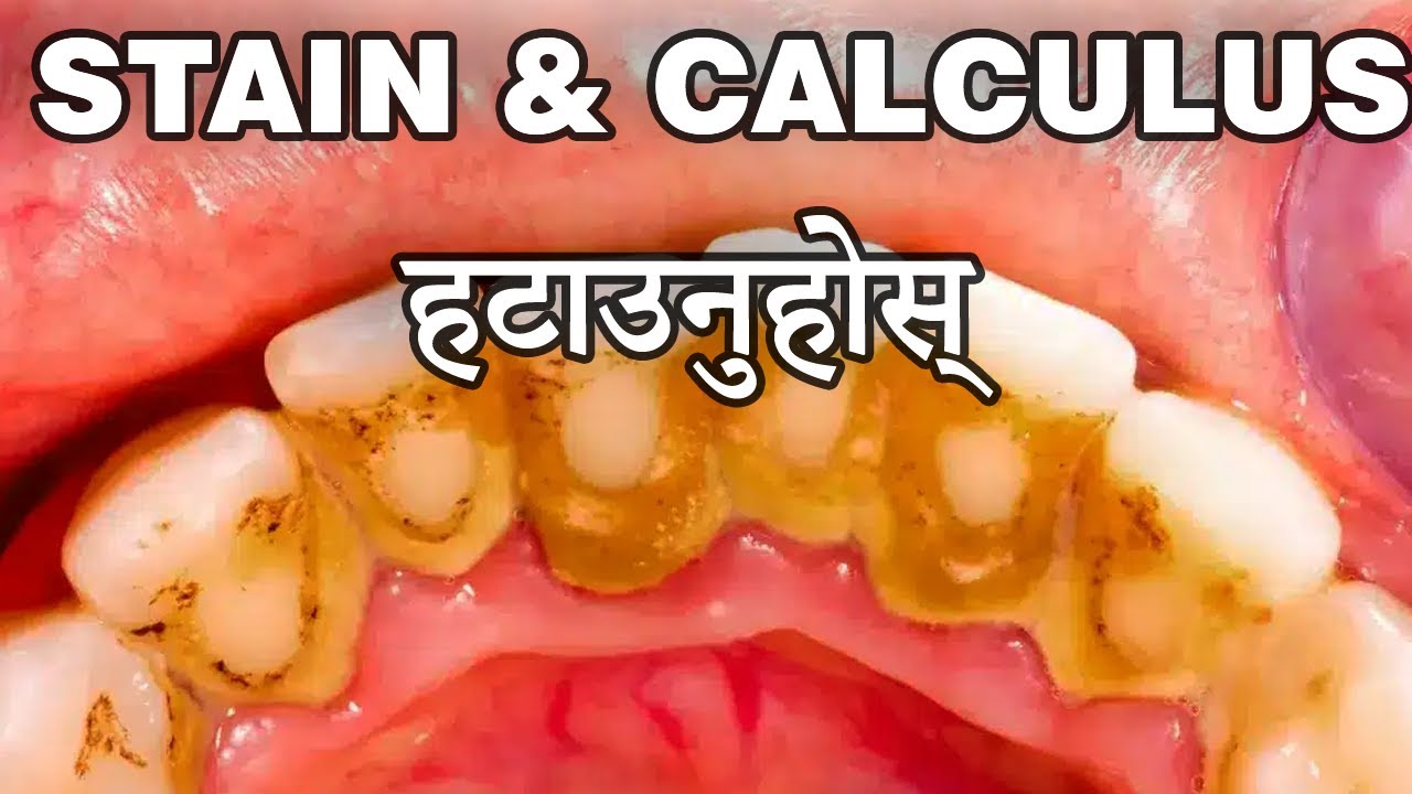 के स्केलिङ(Scaling)  गर्दा दाँत खिइने हो? डराउनु अघि यो भिडियो हेर्नुहोस् ?| Plaque & Tartar Removal