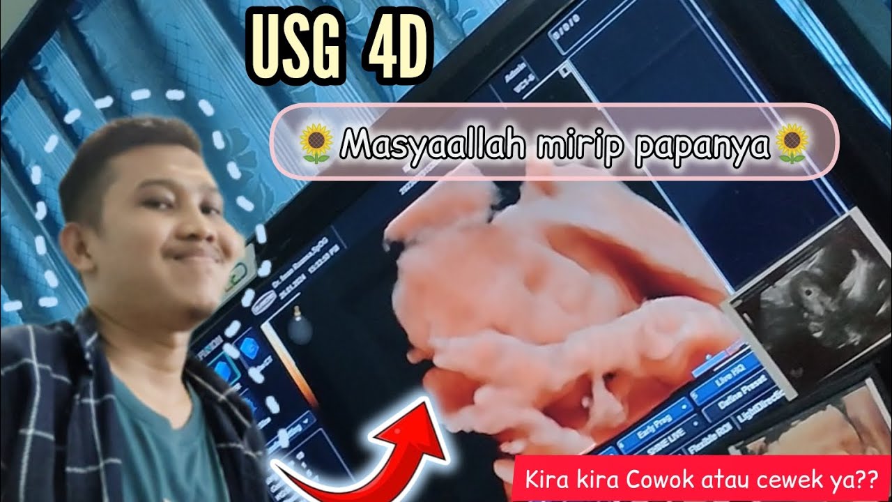 USG 4D| masya allah mirip papanya🤗 |usia kandungan 31 minggu Masya ...