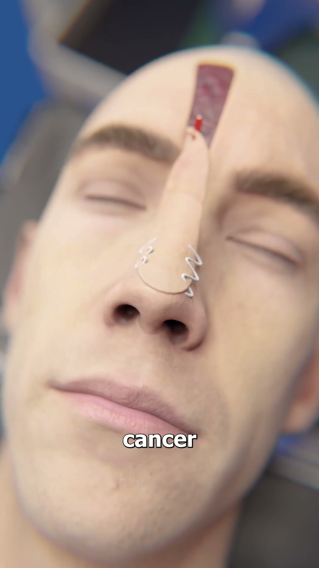 Forehead Flap Surgery ?