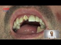 36-Fratura dental total. Como reutilizar o próprio dente com pino de fibra de vidro.Dr: Antônio