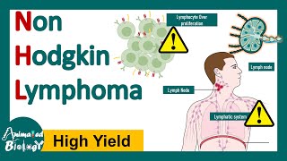 Non Hodgkin lymphoma  | Pathology and genetics of Non Hodgkin lymphoma | Diagnosis and treatment