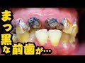 [抜髄]まっ黒な前歯を治療[dentistry][cavity][歯医者][去除蛀牙神經]治療變黑的門牙)