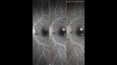 NEOVASCULARIZATION IN CENTRAL SEROUS CHORIORETINOPATHY MULTIMODAL ANALYSIS For more images like this