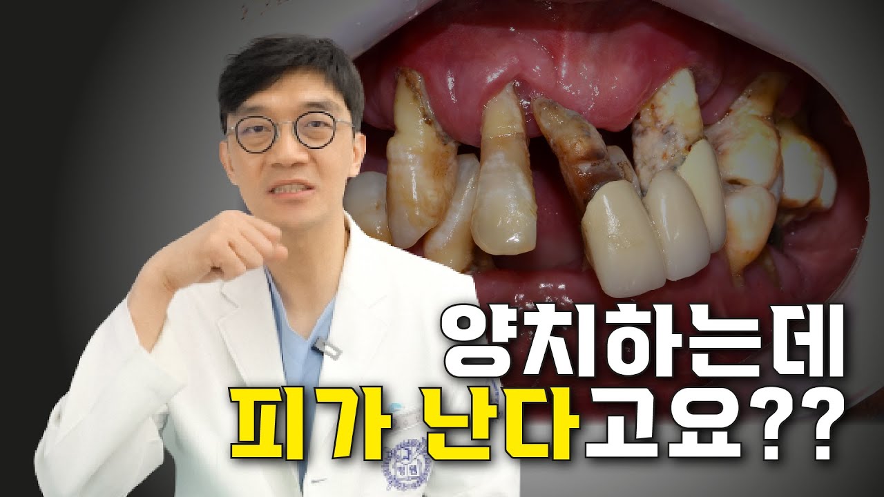 [Bệnh viện Nha khoa One Day] Bạn bị chảy máu khi đánh răng ư?