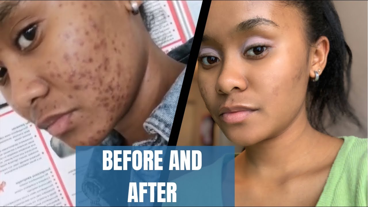 Skin Care Routine. (AFFORDABLE products) how to get rid of acne scars ...