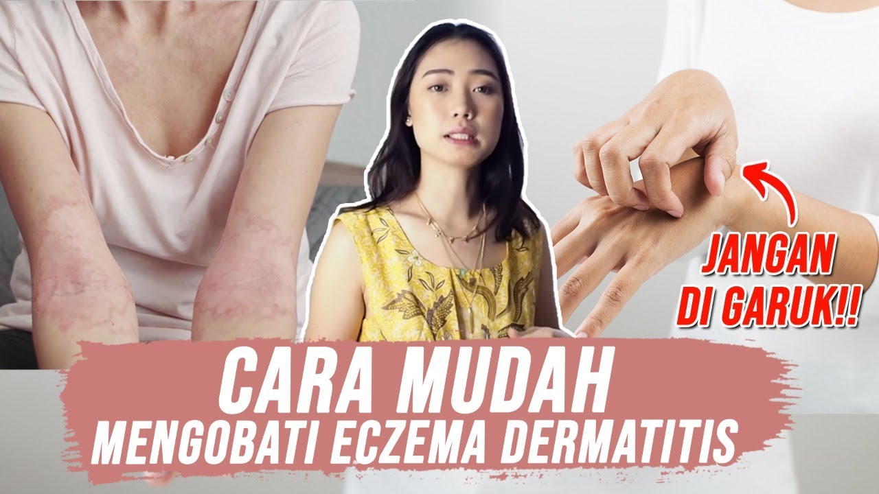 Cara Mengobati Eksim Eczema Dermatitis | Eczema Treatments | Cure
