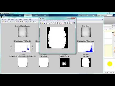 Bone Fractures detection using Matlab Code |Top 5 matlab projects