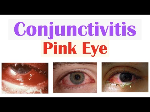 Acute Conjunctivitis (Pink Eye) | Allergic, Bacterial, Viral | Symptoms, Diagnosis, Treatment