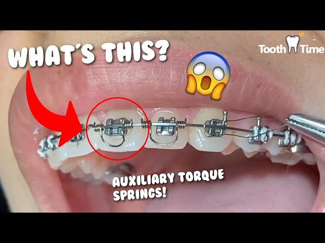 Lot De 50 Auxiliaires Orthodontiques Pour Torquing Radiculaire Antérieur - Neuf Pour Dentistes