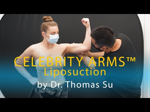 Arm Liposuction Immediate Results | Celebrity Arms™ | Lipo 360 Arms | High-Definition |Expert Dr. Su