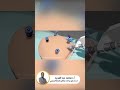فيديو توضيحى خطوات تكميم المعده بالمنظار أ د محمد عبدالمجيد 