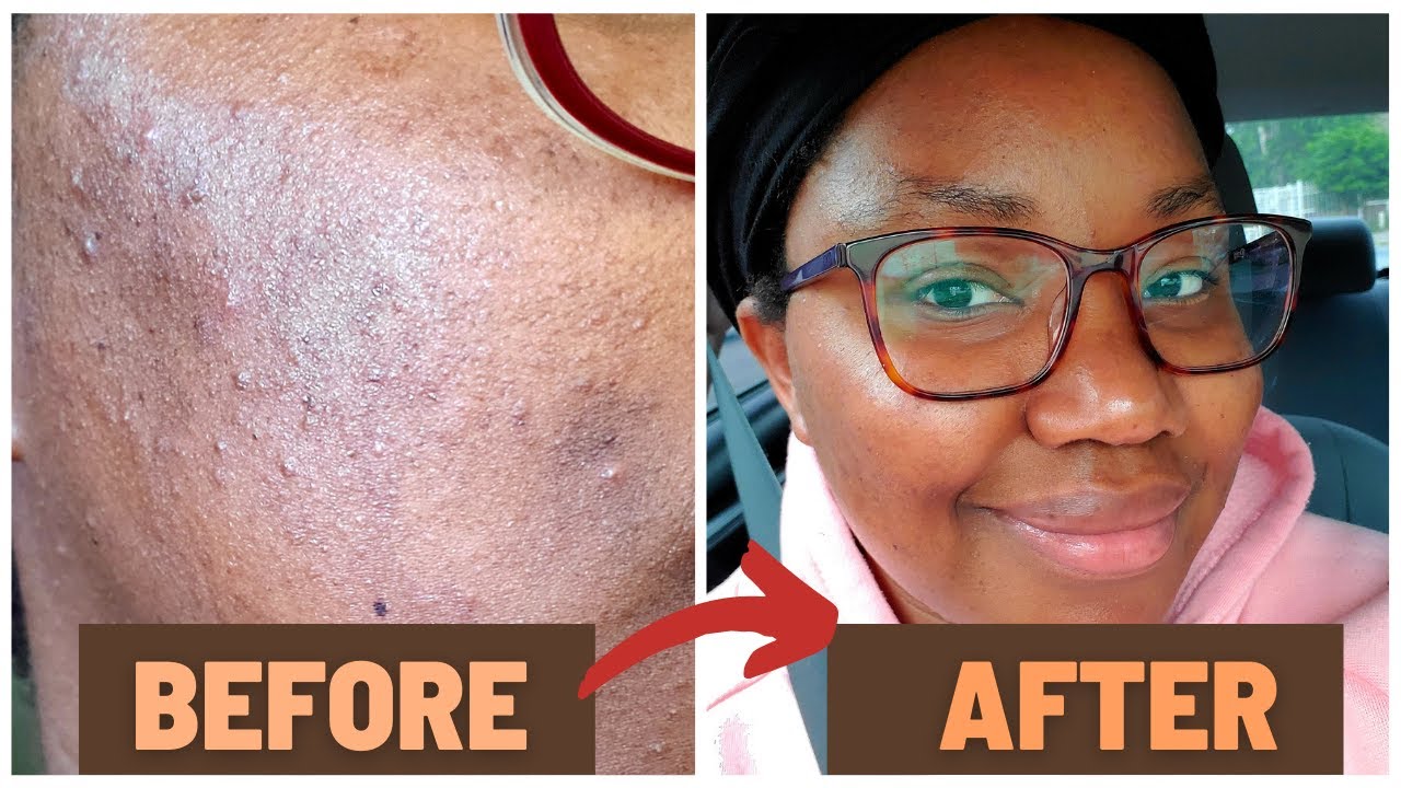 How I Cleared My Acne And Dark Spots IN 7 DAYS | #skincareroutine - YouTube
