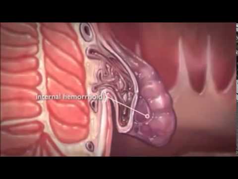 რა არის ბუასილი  (თურმანიძის მალამო)