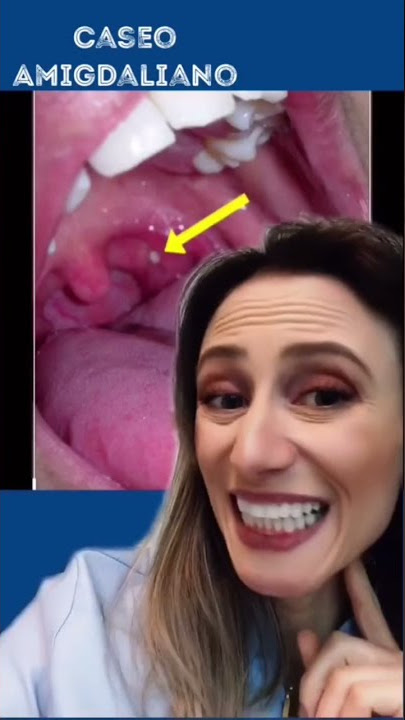 Como que forma essas bolinhas da garganta? #caseoamigdaliano #garganta #amigdala #dentista