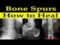 How to Heal Bone Spurs Naturally - Dr Alan Mandell, DC