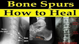 How to Heal Bone Spurs Naturally  Dr Alan Mandell, DC