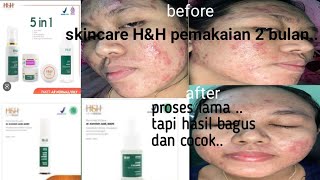 Review jujur skincare viral d tiktok H&H skincare