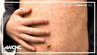 Measles case confirmed in western North Carolina
