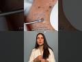Mitesserentfernung 亞 Hautpflege Haut Skincare Skincaretips Hautarztperapp Pickel Pimplefree Mitesserentfernung 亞 Hautpflege Haut Skincare Skincaretips Hautarztperapp Pickel Pimplefree