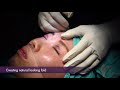 Non incisional blepharoplasty