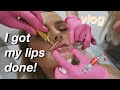 I GOT LIP FILLER?!? | MY EXPERIENCE | BEFORE AND AFTER | Conagh Kathleen
