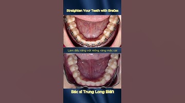 Straighten Your Teeth With Braces - Làm Đều Răng Với Niềng Răng Mắc Cài | Bác sĩ Trung Long Biên