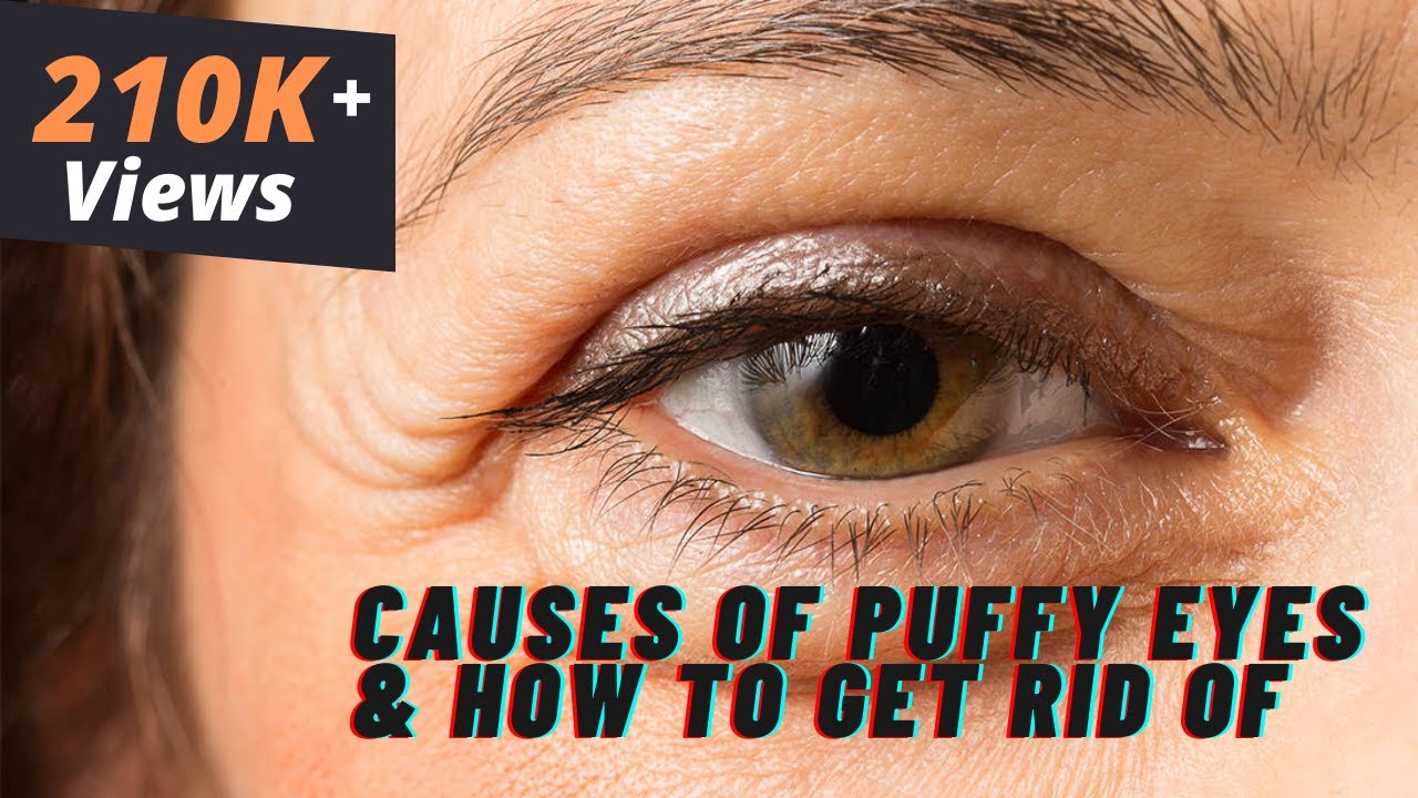 What causes puffy eyes?