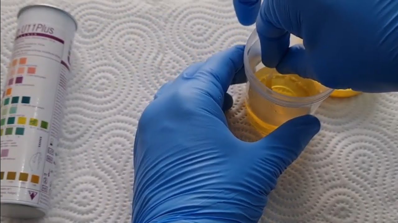 מבוא לבדיקות מעבדה: סטיק שתן