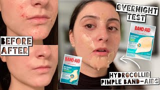 TESTING HYDROCOLLOID BAND-AIDS FOR MY ACNE | Hydro Seal Patches | Week Test