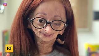 Adalia Rose Youtube Star With Rare Disorder Dead At 15