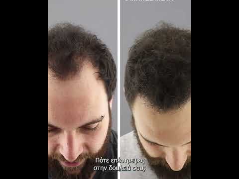 Μεταμόσχευση μαλλιών - Αποτέλεσμα 6 μήνες Μετά -  υπότιτλοι