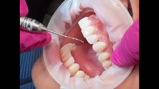 Porcelain Veneers in Glendale, CA – Complete Smile Makeover Transformation