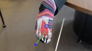 Hololens Penn Ir - Ablation With Virtual Needle Track