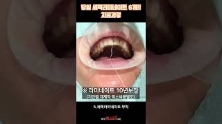 대구 당일 세렉라미네이트 6개치료과정!! (대구예스타치과) #shortsvideos