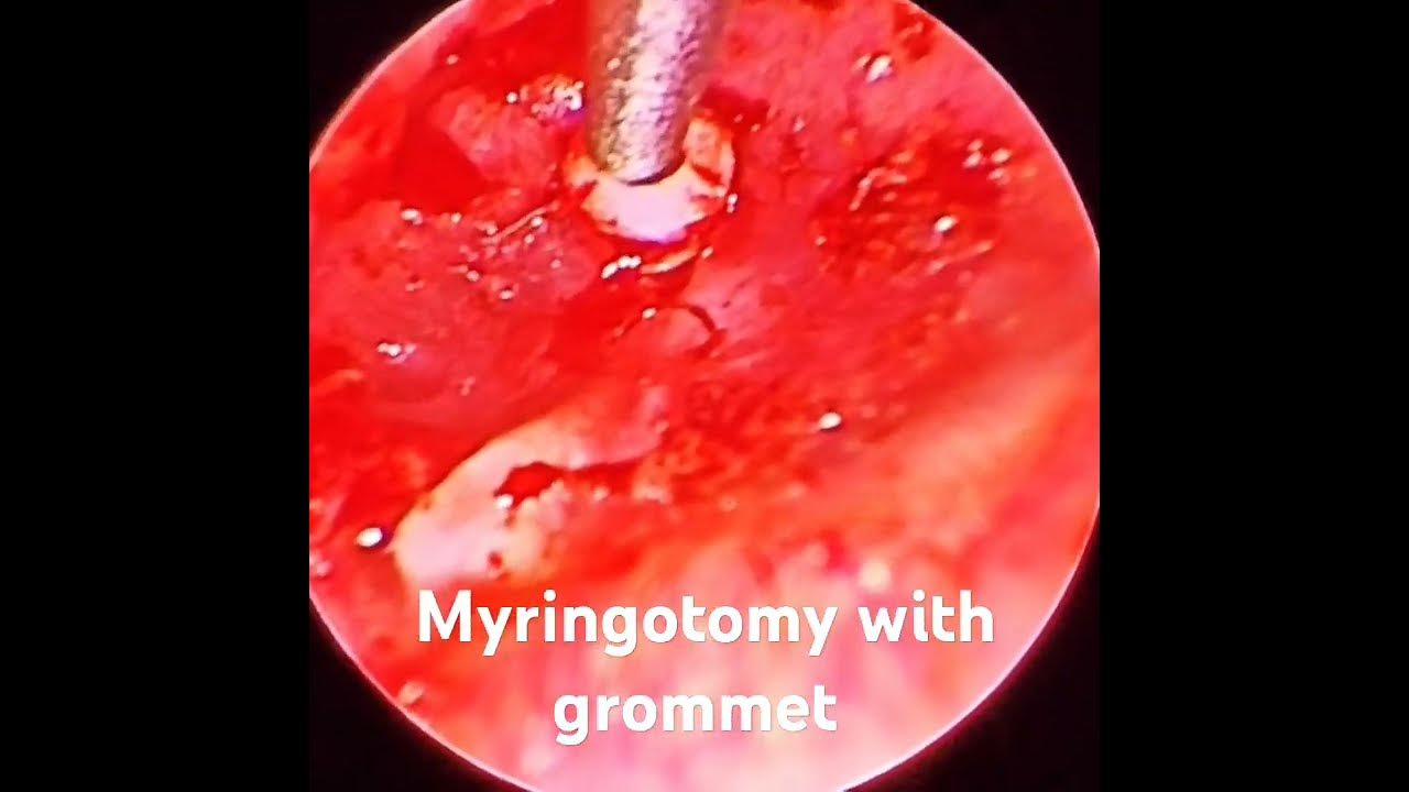Endoscopic myringotomy with grommet YouTube