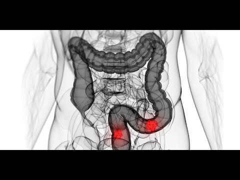 Ракът на дебелото черво вече поразява и по-млади хора!