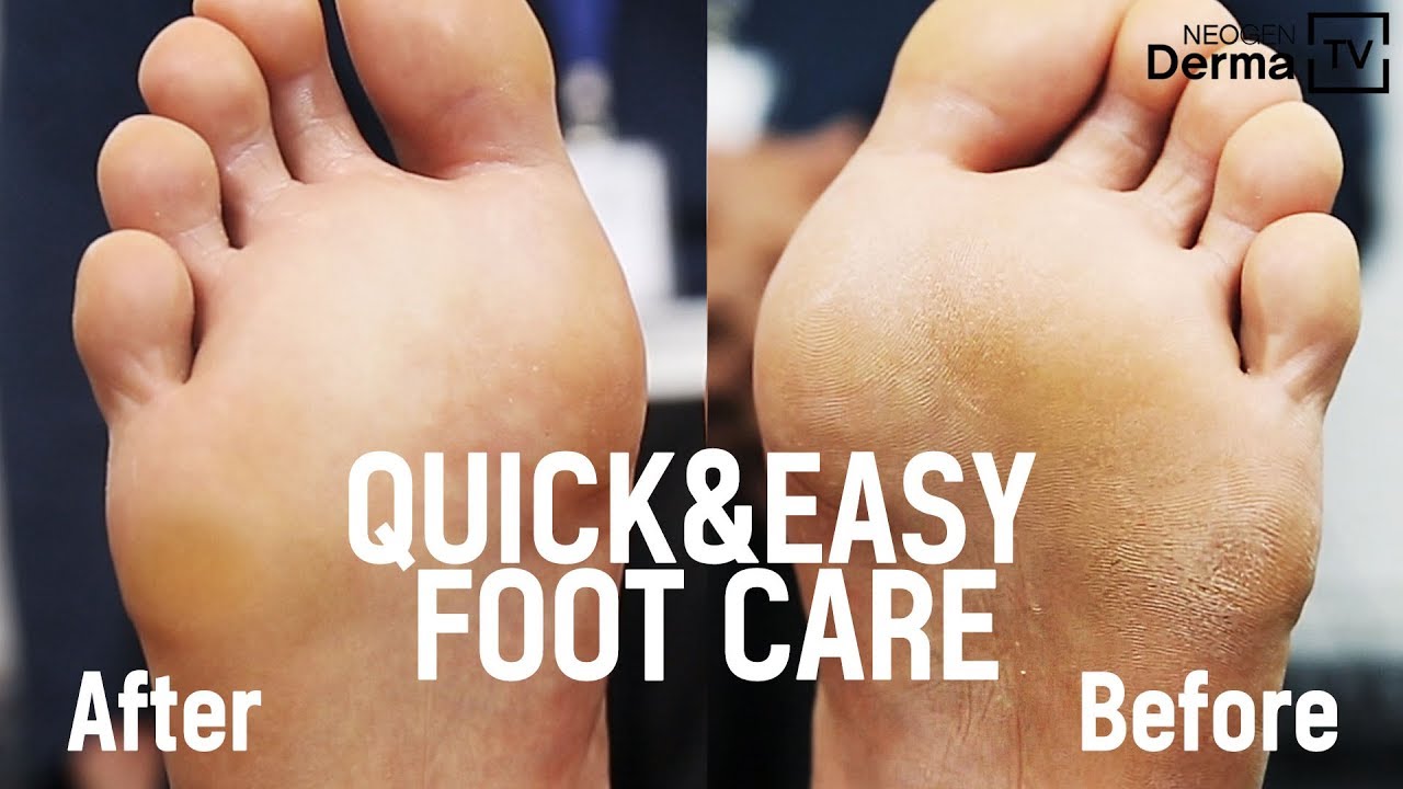 Fast and Easy Care to Remove Cracked Heels & Foot Dead Skin Cells 