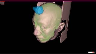 Multi-Pass Rendering using vulkan to show tumor in human head