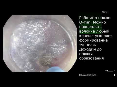 Удаление лейомиомы пищевода методом STER. Опыт НМИЦ онкологии имени Н.Н. Петрова