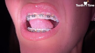 Getting Braces off - anxious patient - Adult Braces - Tooth Time Family Dentistry New Braunfels