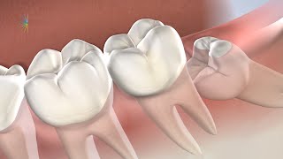 Post-Operative Instructions: Following Wisdom Tooth Removal | Oral Surgery Specialists of Oklahoma
