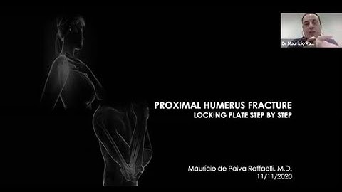 Proximal Humerus Fractures (Locking Plate step by step )(Dr. Mauricio de Paiva Raffaelli )