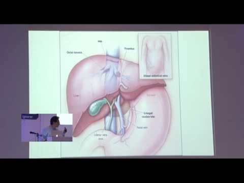 Trombosis  Intra-abdominal  y Senos Venosos. Perspectiva  hematológica