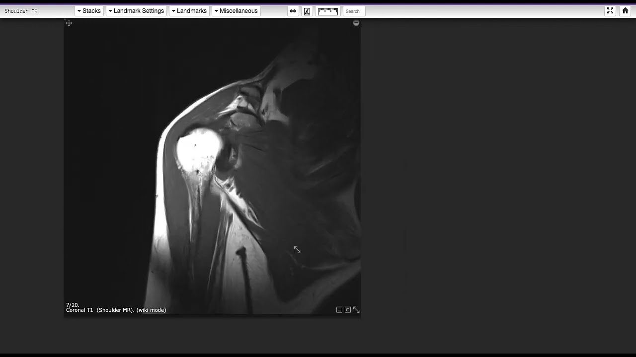 RESONANCIA DE HOMBRO NORMAL | Descripción anatómica.