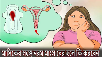 মেয়েদের পিরিয়ডের সাথে নরম মাংস বের হলে যে বড় ক্ষতি হয় দেখুন | Health Trick Tips