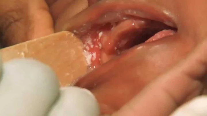 Thrush (French) - Newborn Care Series