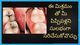 పిప్పిపళ్లని సులభంగా సరిచేసుకోవొచ్చు Tooth decay Tooth cavity Teeth Telugu Portal